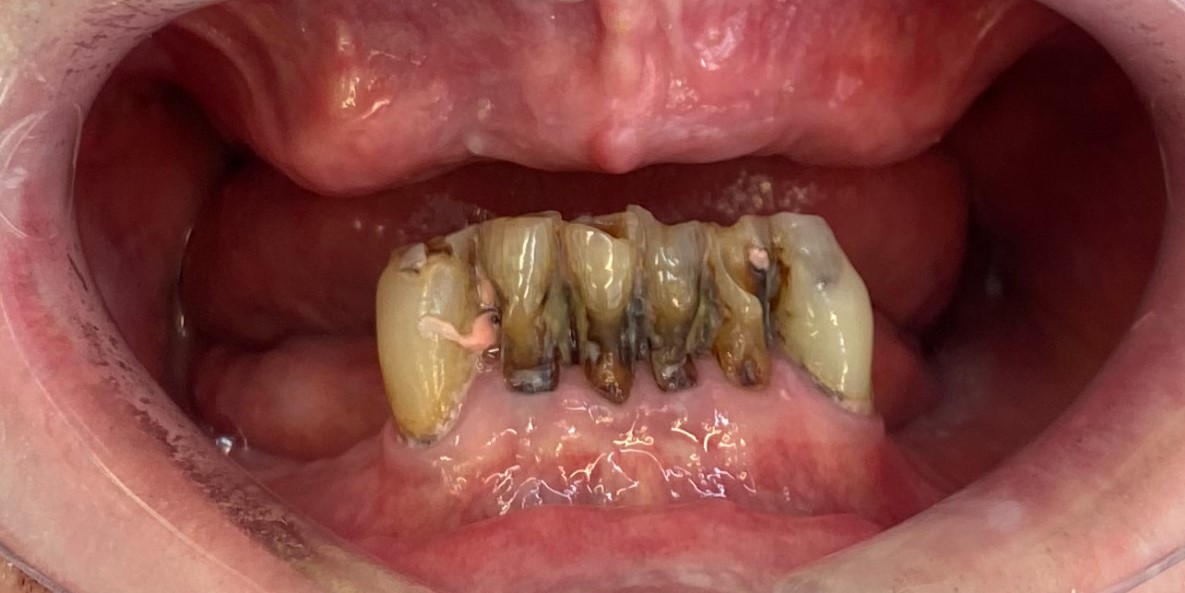 All on 4 Dental Implants (Before) (1)