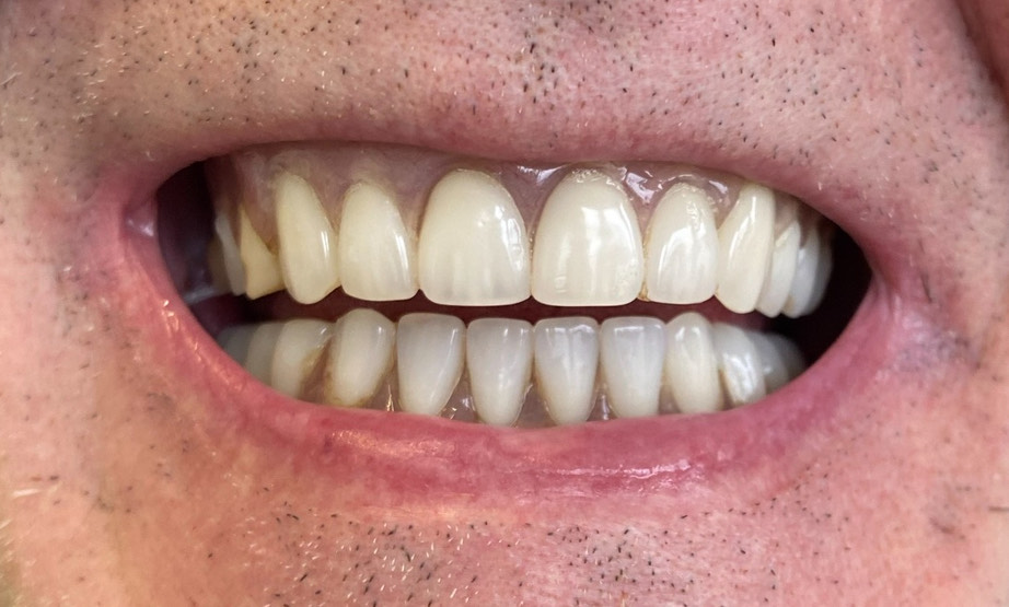 All on 4 Dental Implants (after)