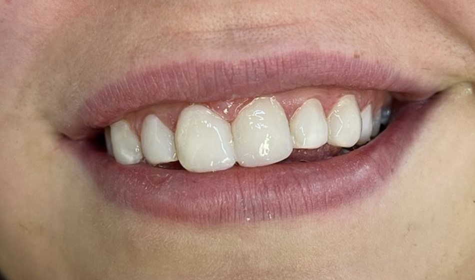 Composite Bonding (After) (1)