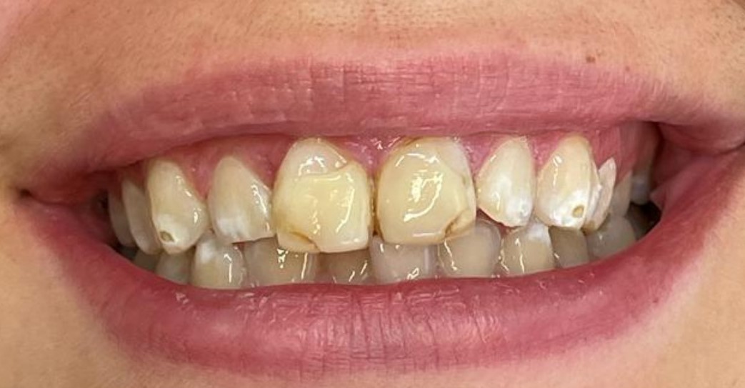 Composite Bonding (Before)